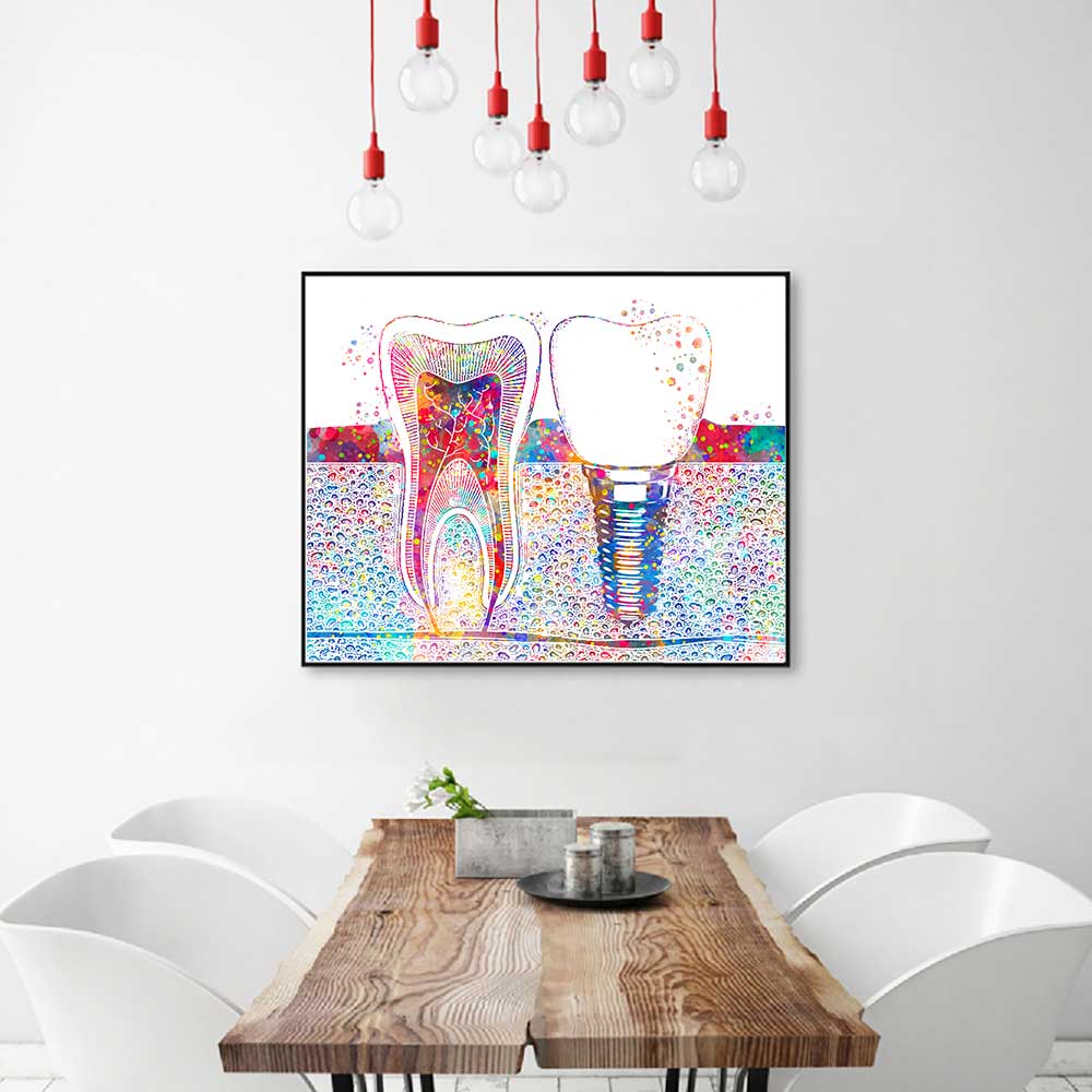 Tooth Implant 100% Cotton Canvas Wall Art Print featuring a detailed and artistic illustration of a tooth implant, designed to enhance the decor of dental offices, clinics, or home spaces with a professional and educational touch.